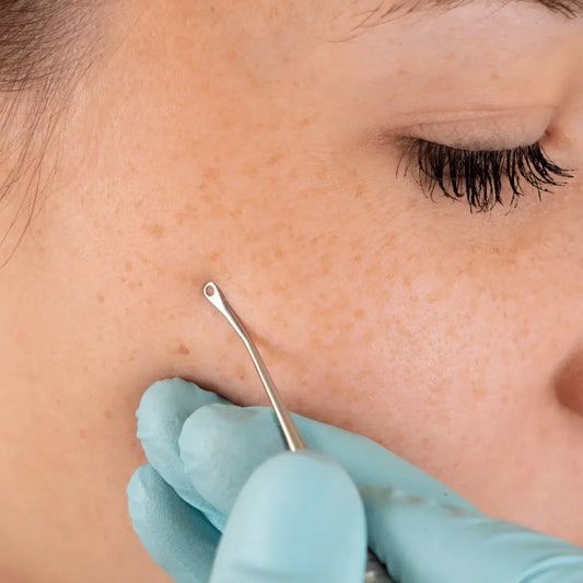 Komedonenheber am Gesicht