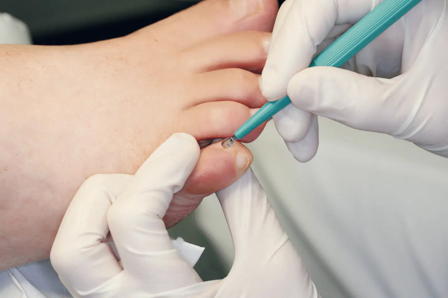 Hautkürette, Ø 4 mm, 1 Stück